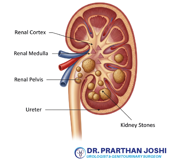 Kidney Stone Treatment in Ahmedabad