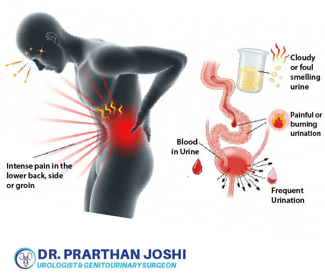 Symptoms of Kidney Stone | Kidney Stone Treatment