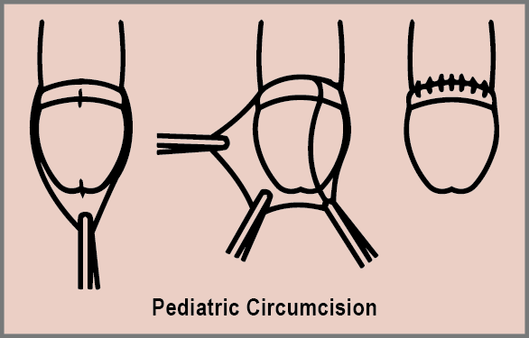 Paediatric Circumcision: A Safe and Gentle Surgical Option for Children