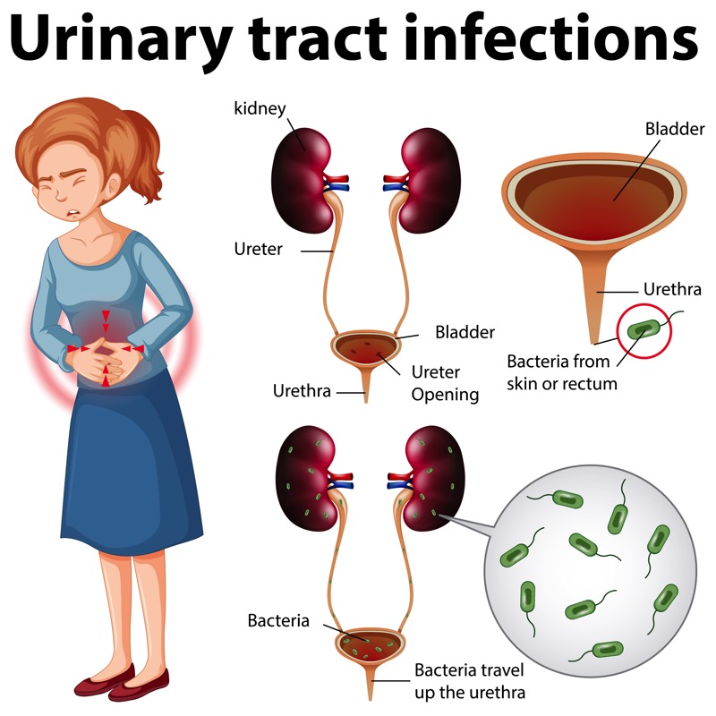 Urinary Tract Infections: Symptoms, Causes, and When to Seek Treatment