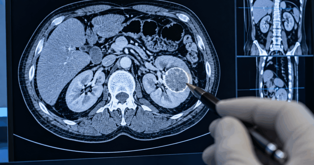 Kidney Cancer Surgery in Ahmedabad — Expert Nephron-Sparing & Radical Nephrectomy by Dr. Prarthan Joshi